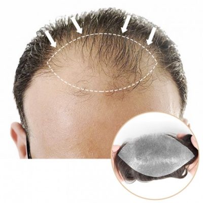 heavy receding hairline patch covering receding hairline and head top